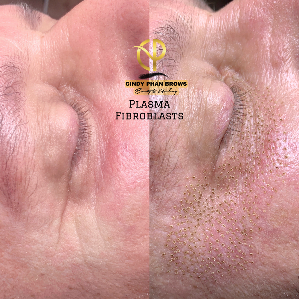 Lower Lid & Crows Feet Plasma