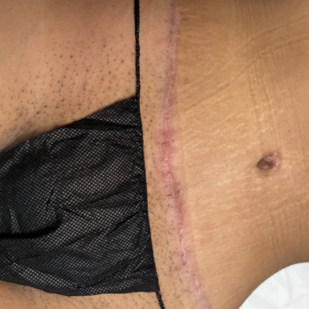 Tratamiento De Cicatriz at Cuerpo Latina Esthetic in Lakeland, FL