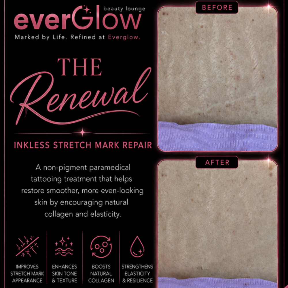 The Renewal: Inkless Stretch Mark at Ever Glow Beauty Lounge in Lubbock, TX