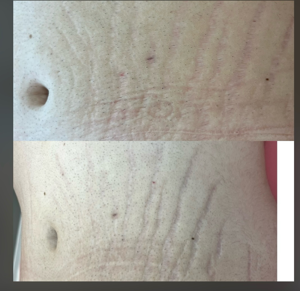 Stretch Mark Repair: Upper Abdomen