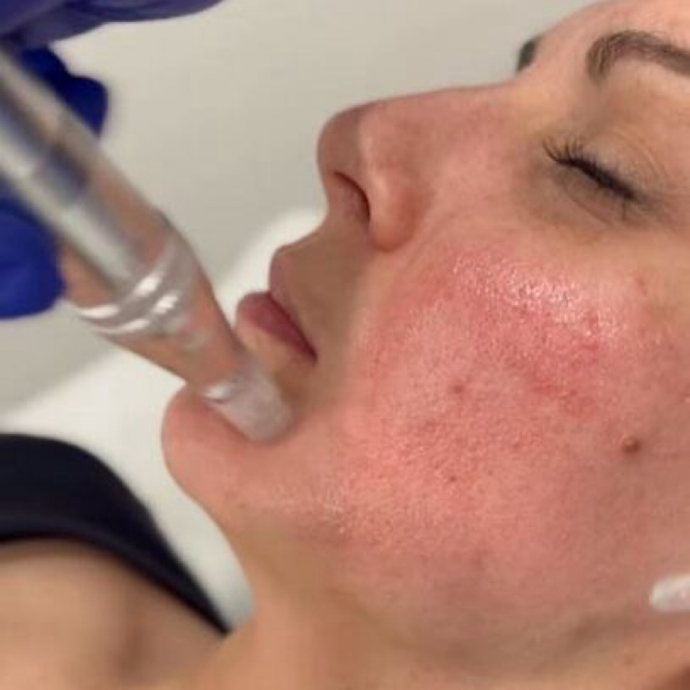 Collagen Revival Microneedling at Skin Revival Aesthetics in Ammon, ID