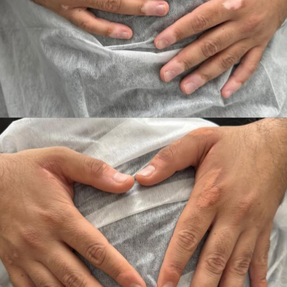VITILIGO at PMU ink and beauty in Monterey, CA