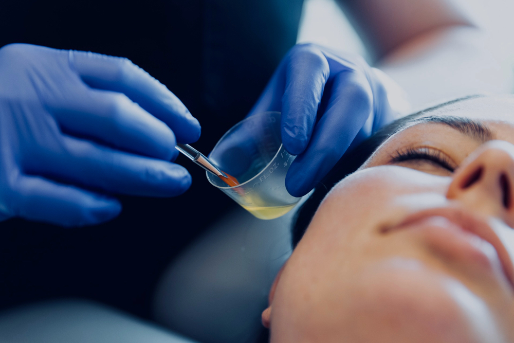 Chemical Resurfacing Treatment