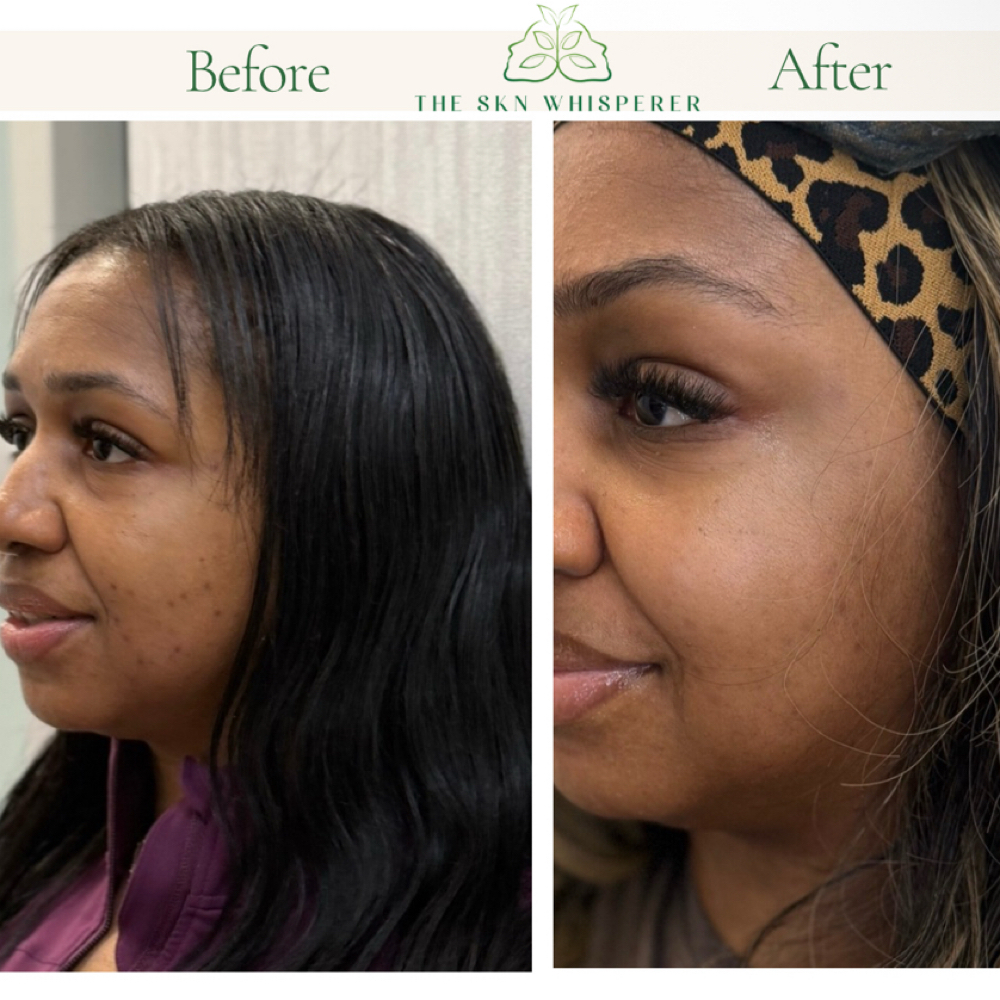 Procell Microchanneling at The SKN Whisperer in Atlanta, GA