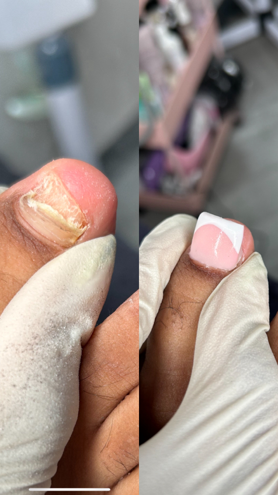 Toe Nail Reconstruction