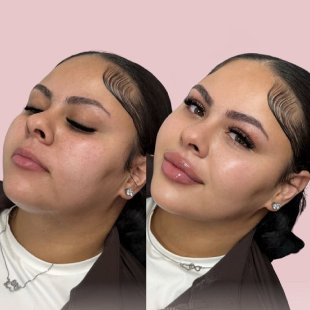 Undereye Filler at Aesthetics by Amina in New York, NY