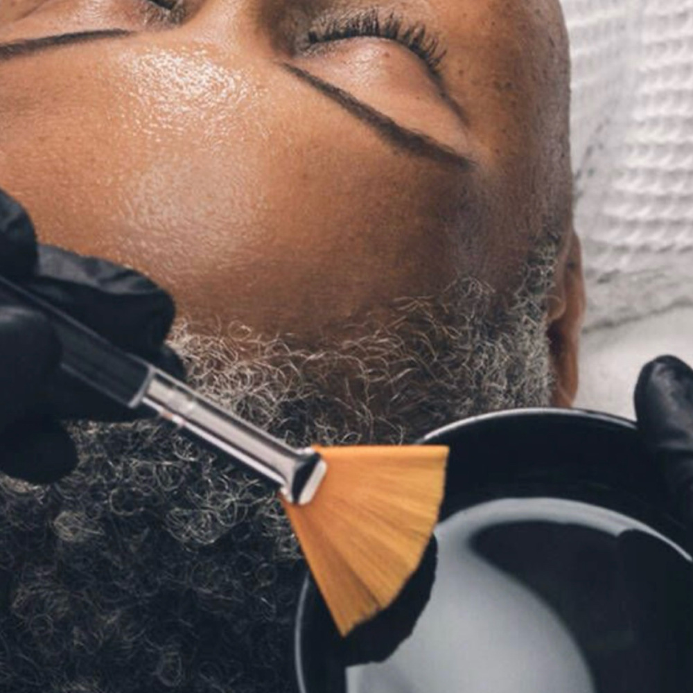 Chemical Peel