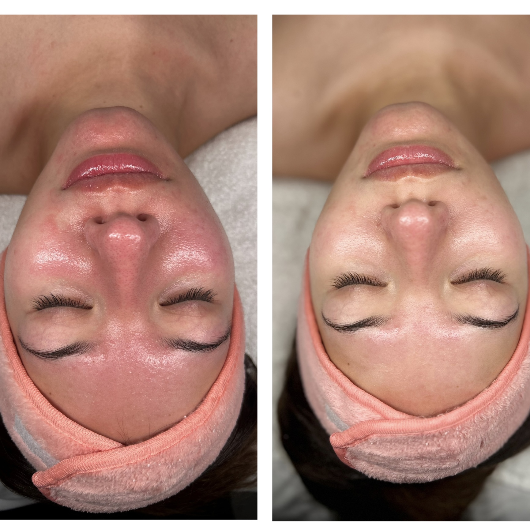 Customized Facial