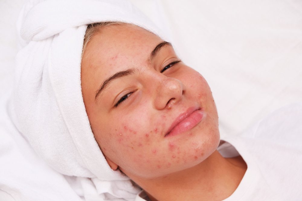 Advanced Acne Correction Facial✨