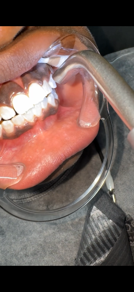 Teen Whitening