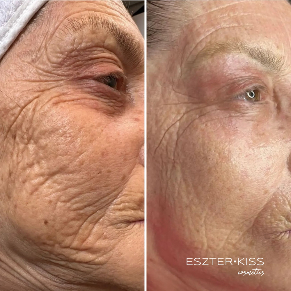 Full Face Plasma Fusion at Eszter Kiss Cosmetics in Deltona, FL