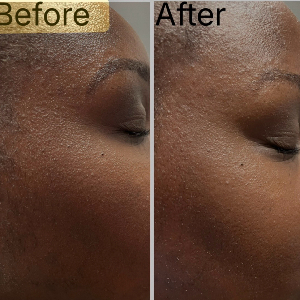 Chemical Peel at Jubee Boutique MedSpa in Annapolis, MD