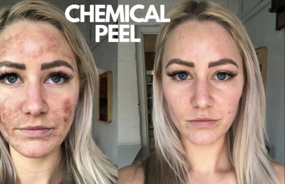 Chemical Peel