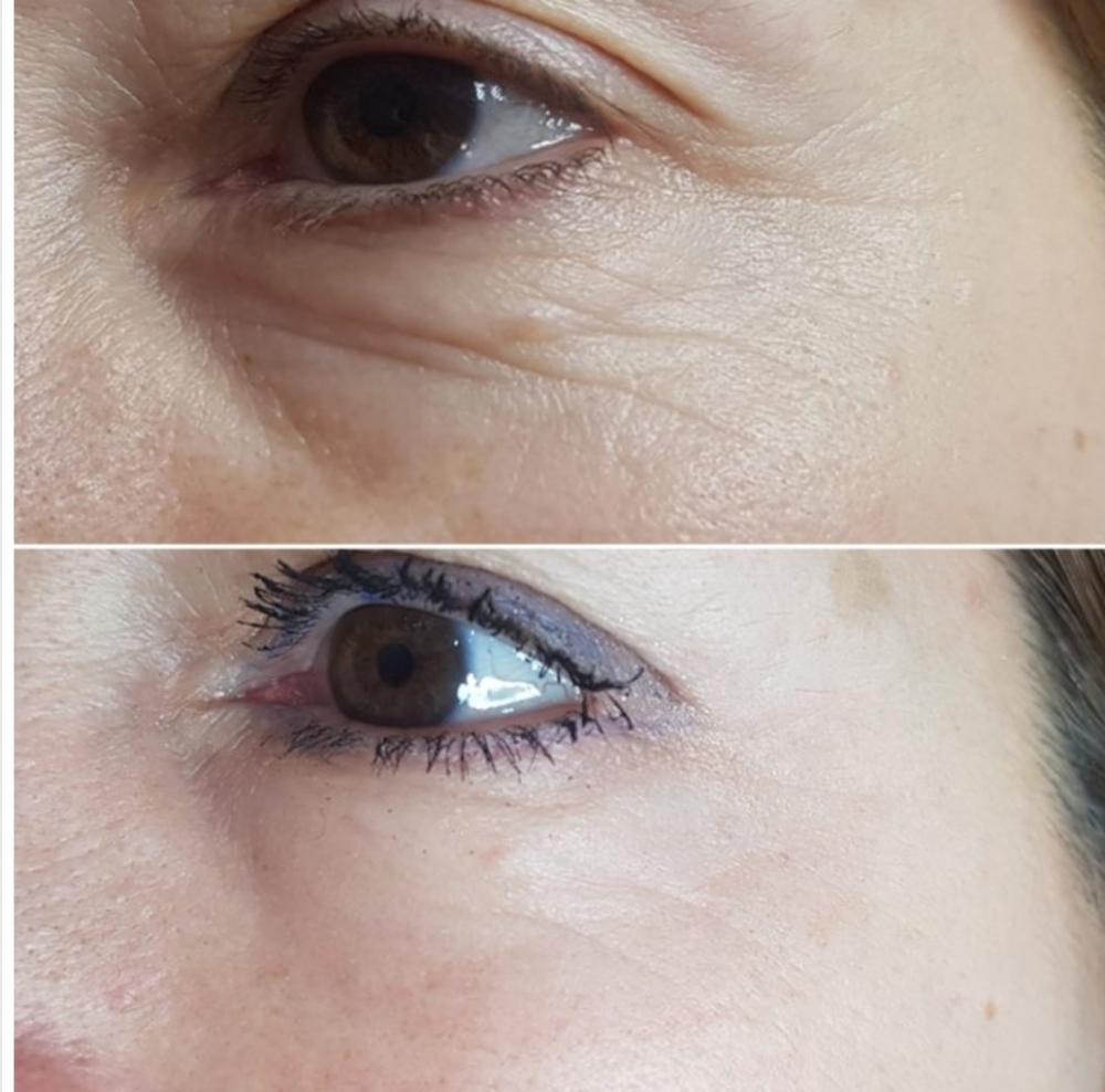 Fibroblast Lift_under Eye