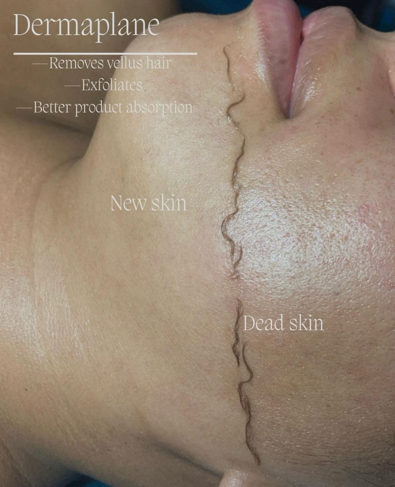 Dermaplaning Facial