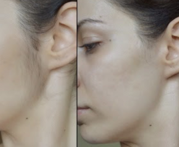 Sideburn Threading