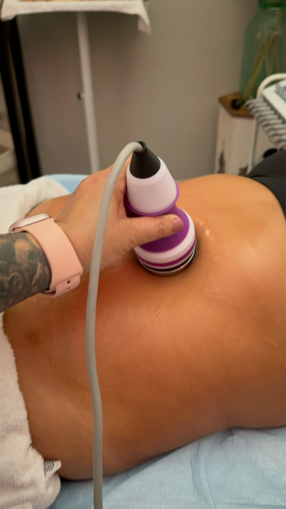 Radio Frequency Skin Tightening