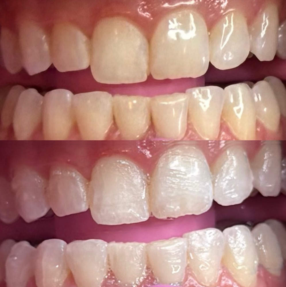 Express Whitening For 1 at Bright White Co. in Crosslake, MN