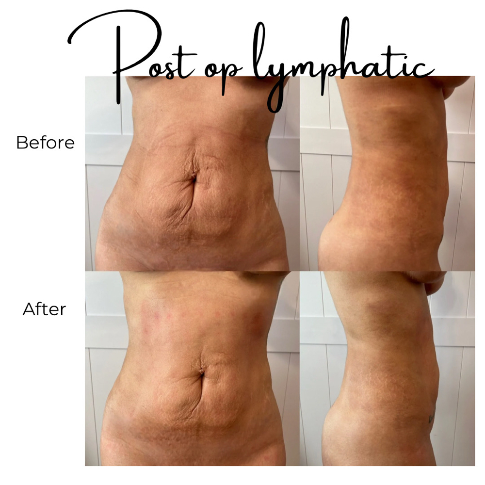 Lymphatic