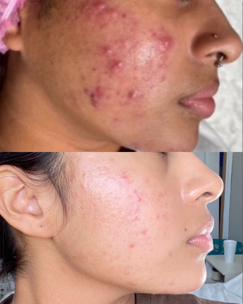 Acné Treatment