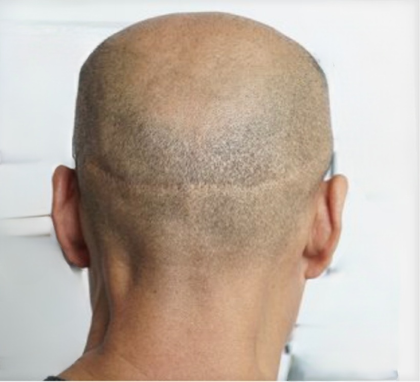 SCALP SCAR CAMOUFLAGE