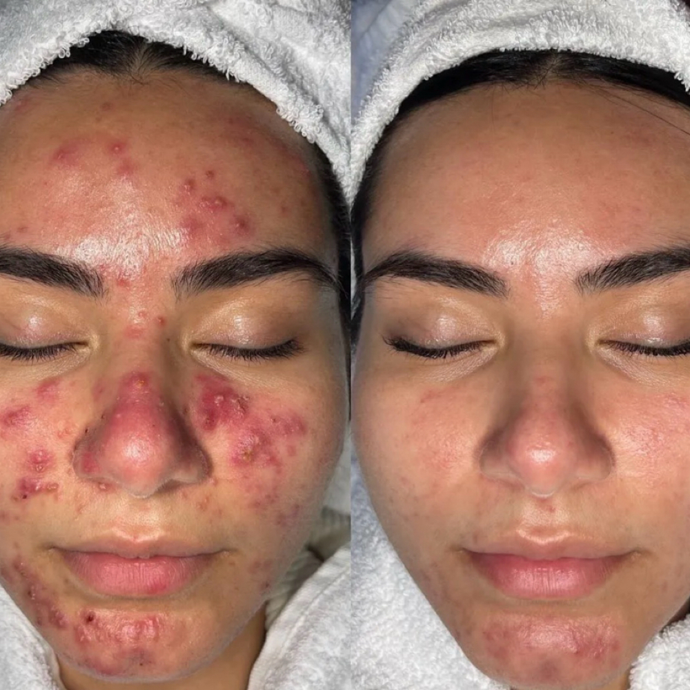 Clarifying Acne Facial at By Mere in Canal Fulton, OH