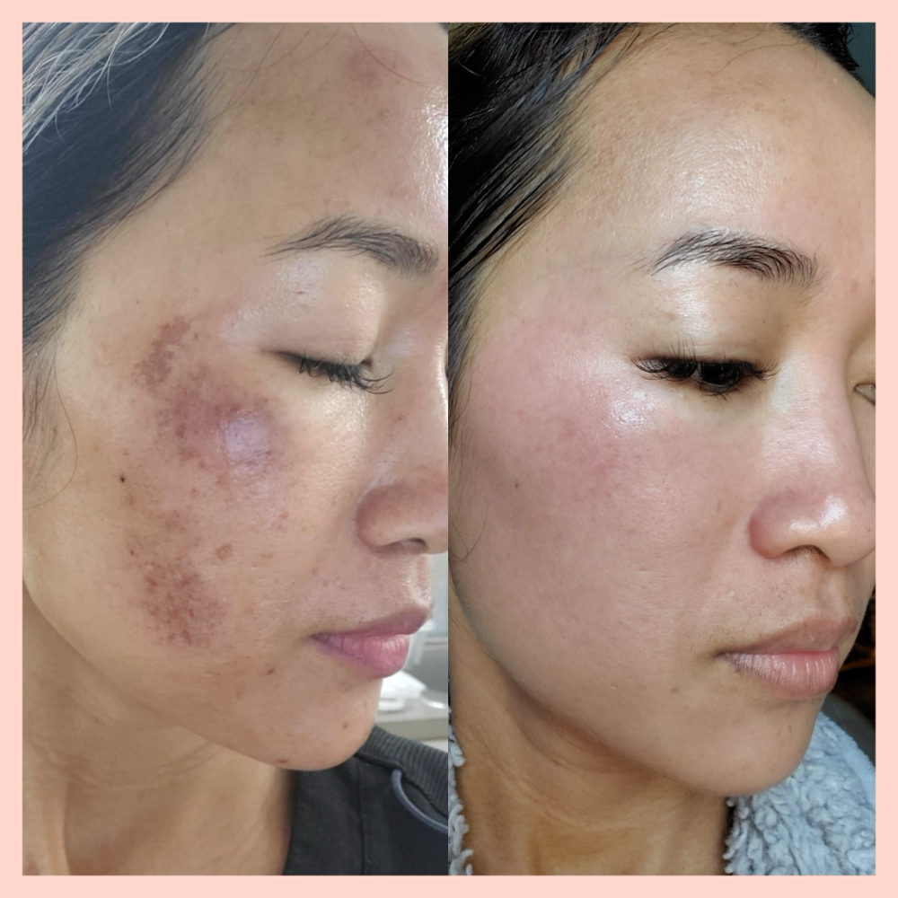 Melasma Treatment at Kay Spa & Brows in Tukwila, WA