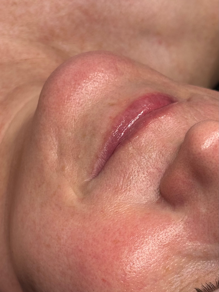 the hydrafacial at Butler Skin in Sheridan, WY