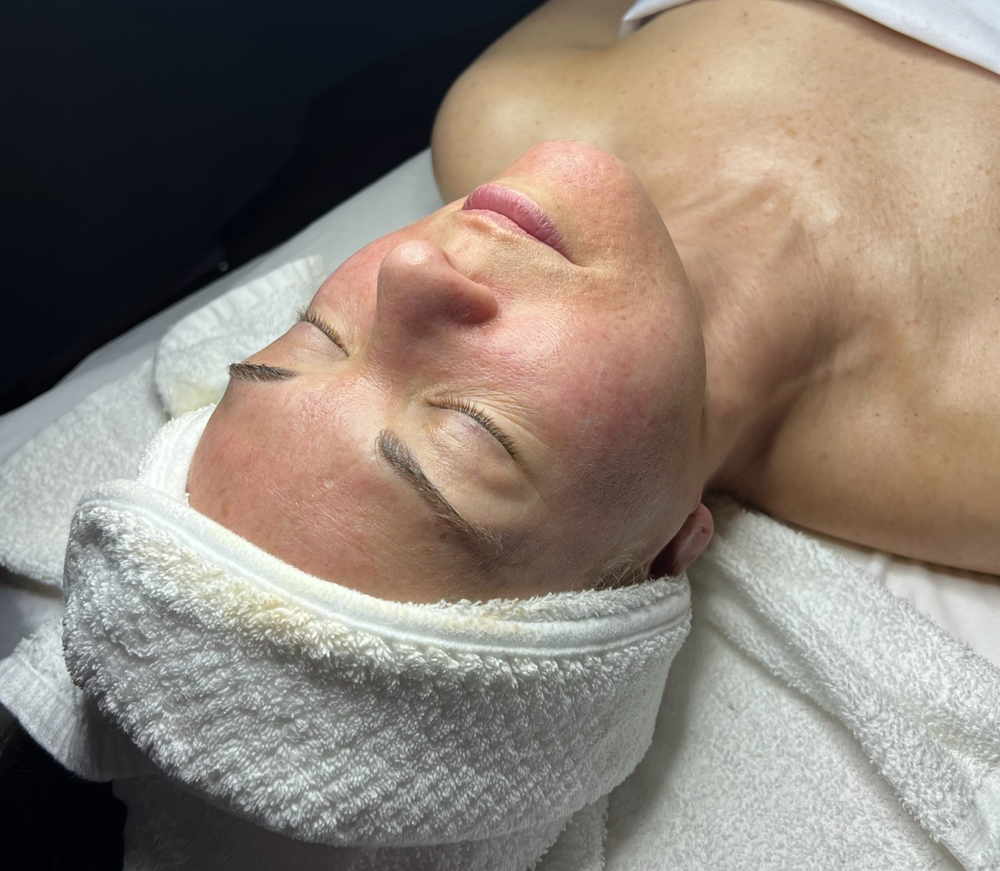 Chemical Peel