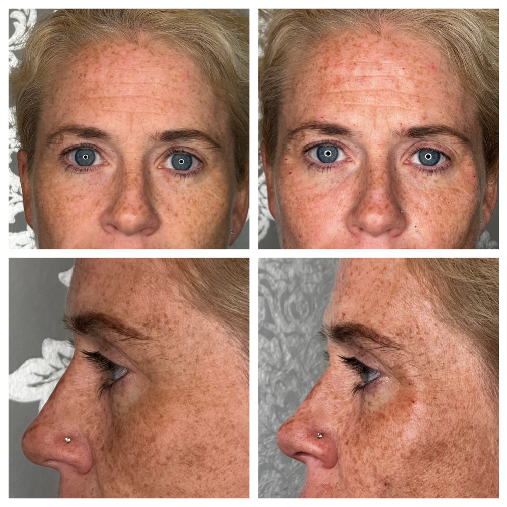 Cheek Filler at SCL Aesthetics in Putnam, CT