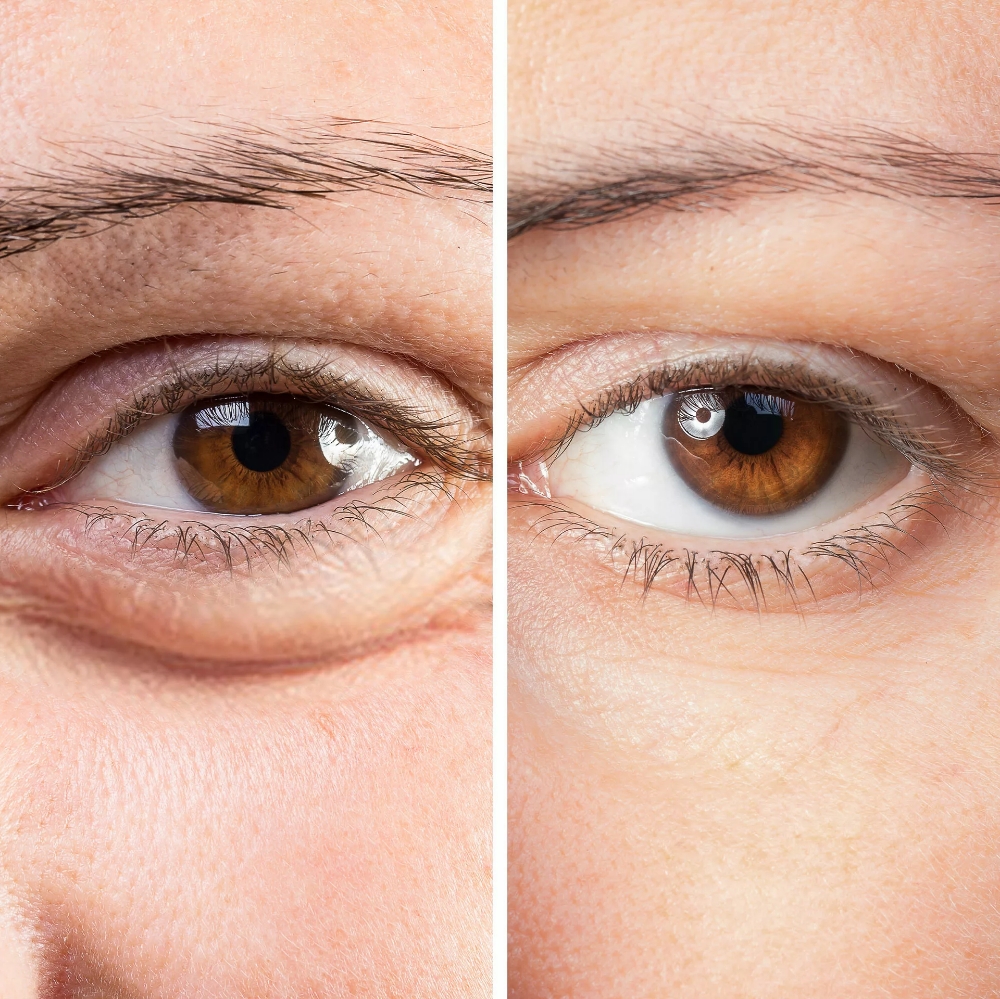 Juvederm Volux