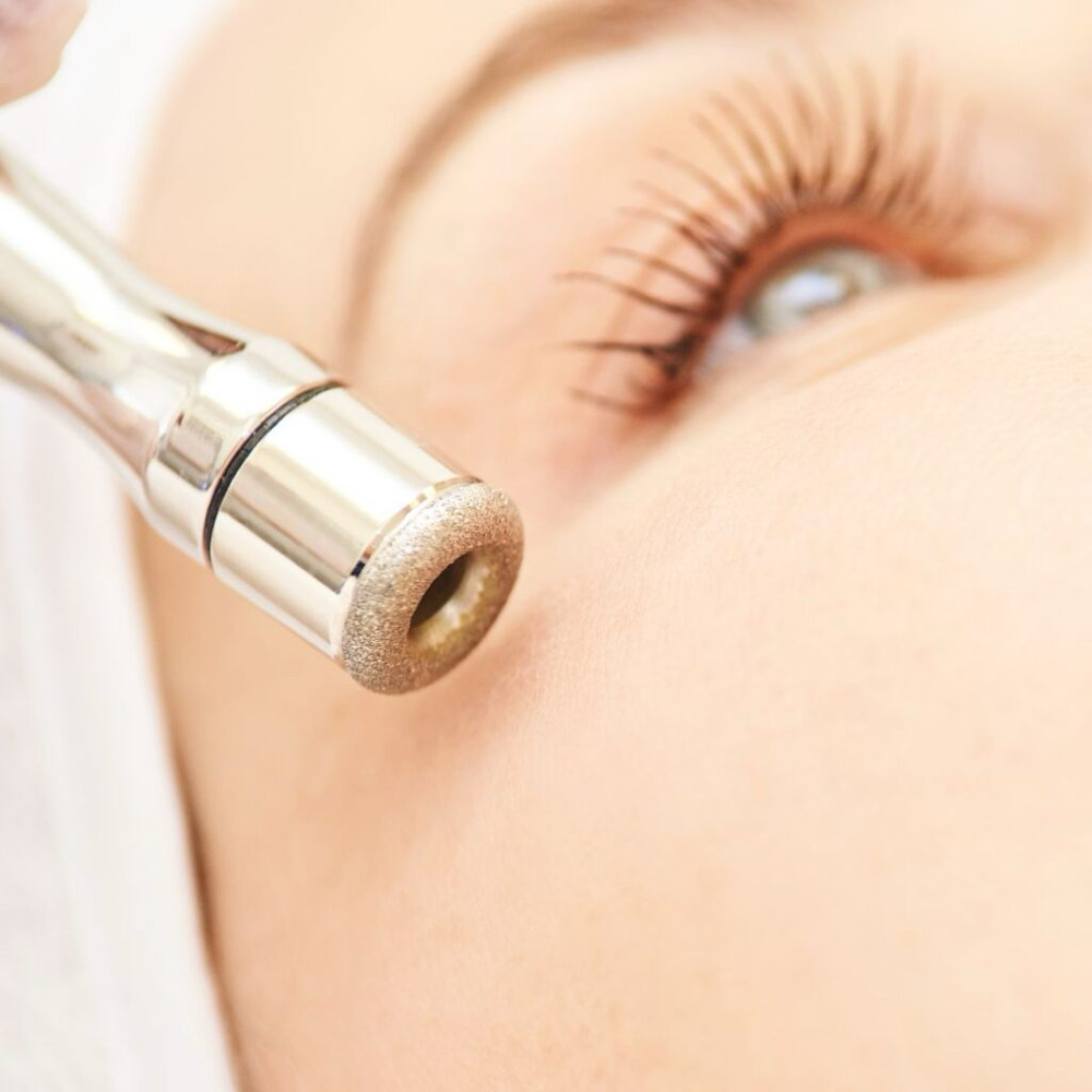 Microdermabrasion Exfoliation