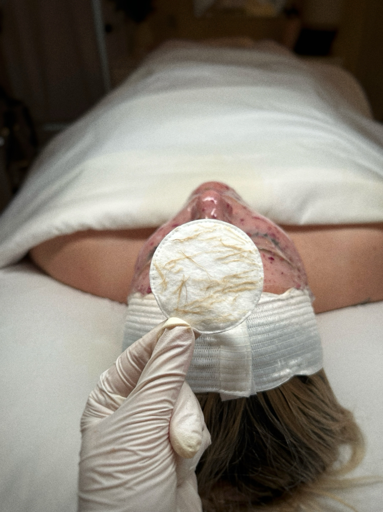 Dermaplane Facial