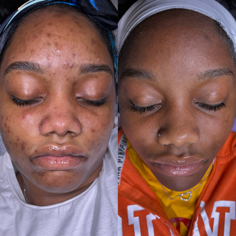 Mae Bevella Acne Treatment