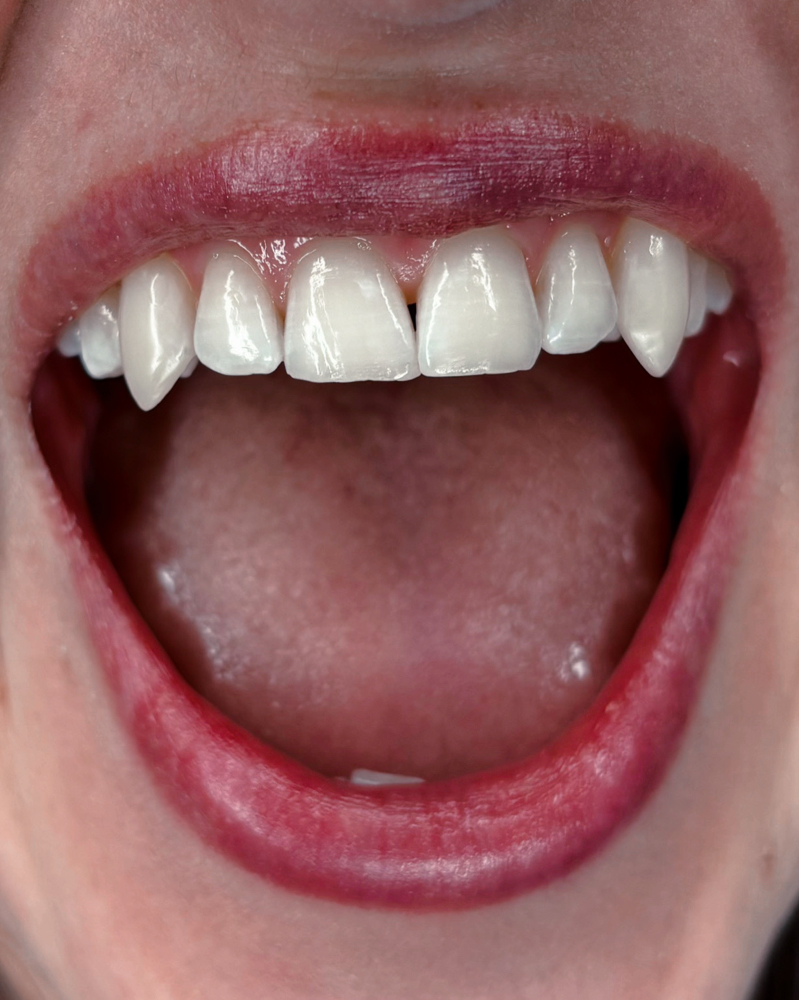ViperVeneers