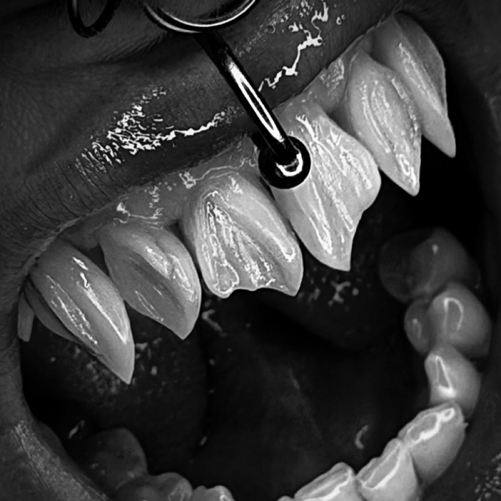 Cosmetic Fangs at X001 in Los Angeles, CA