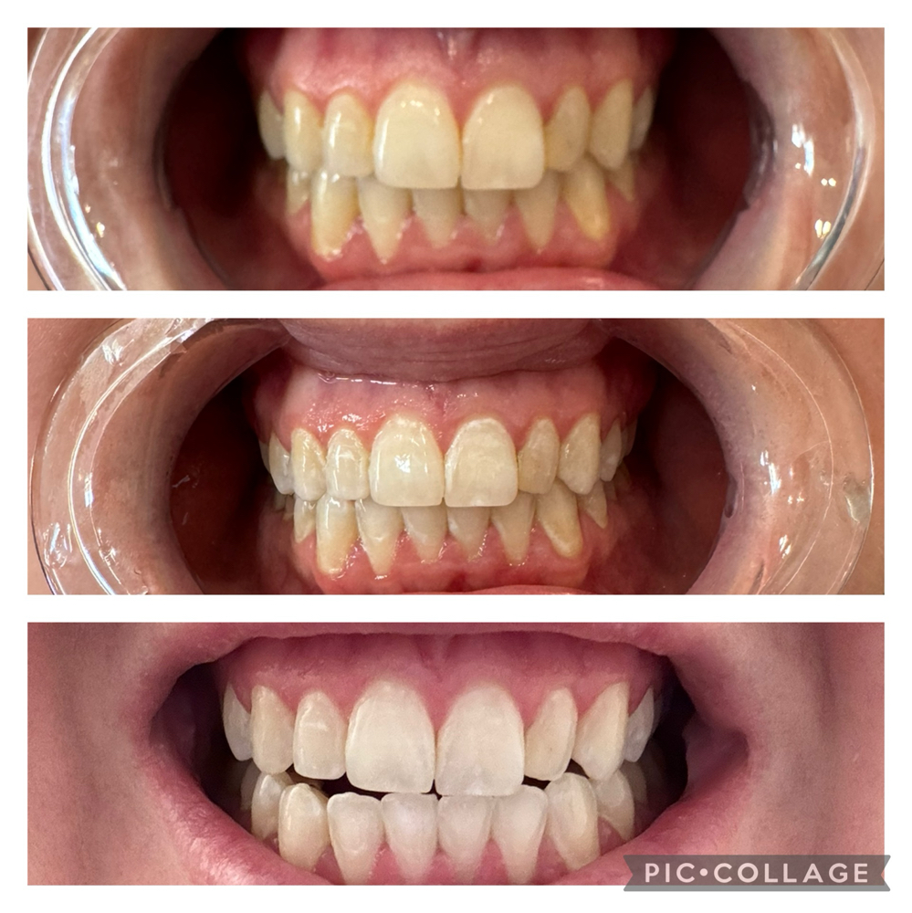 Teeth Whitening