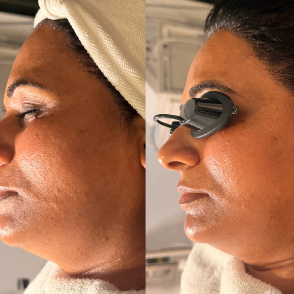 Level I Chemical Peel at Radiance Aesthetics by Aracely in Bakersfield, CA