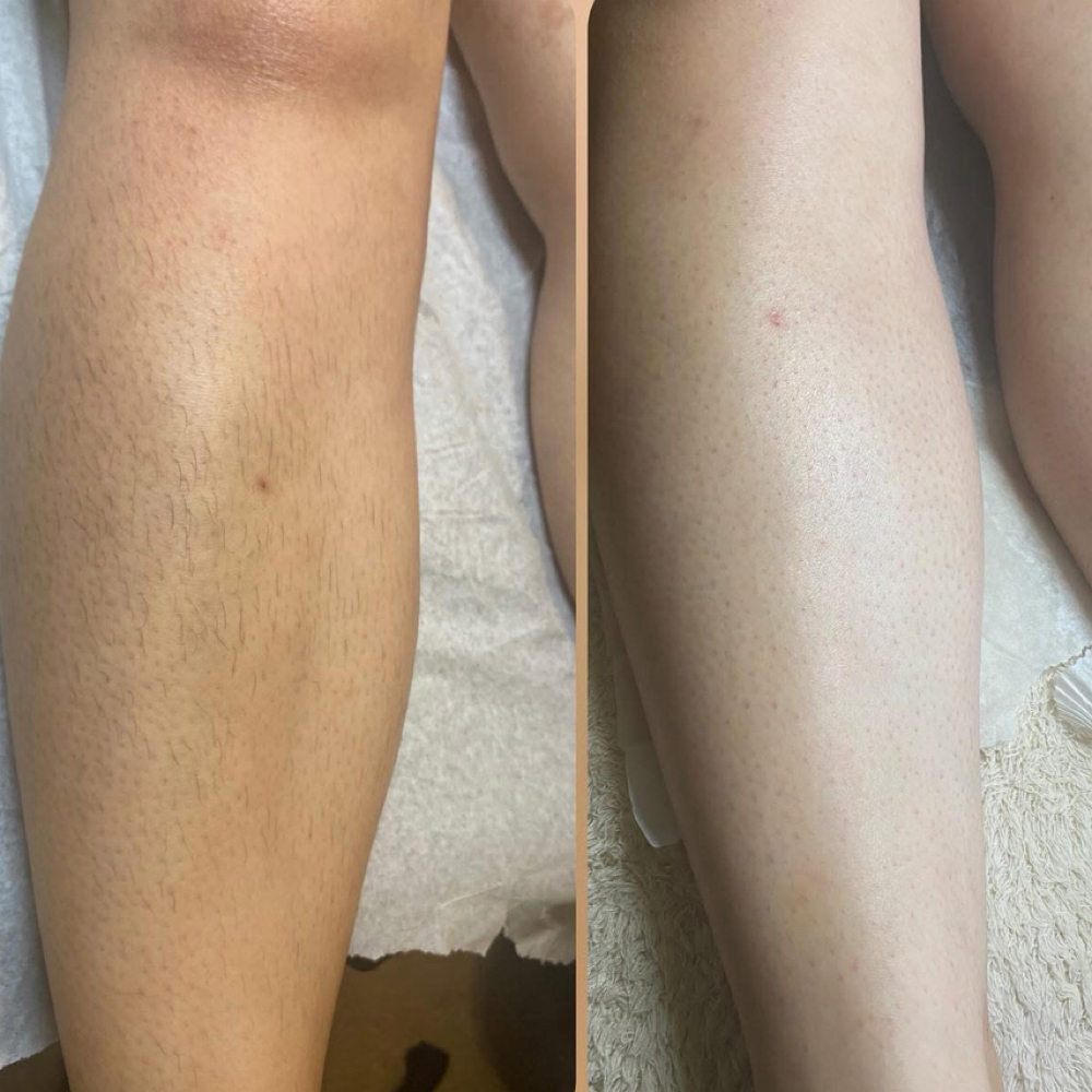 Legs at The Aesthetix Lounge in San Clemente, CA