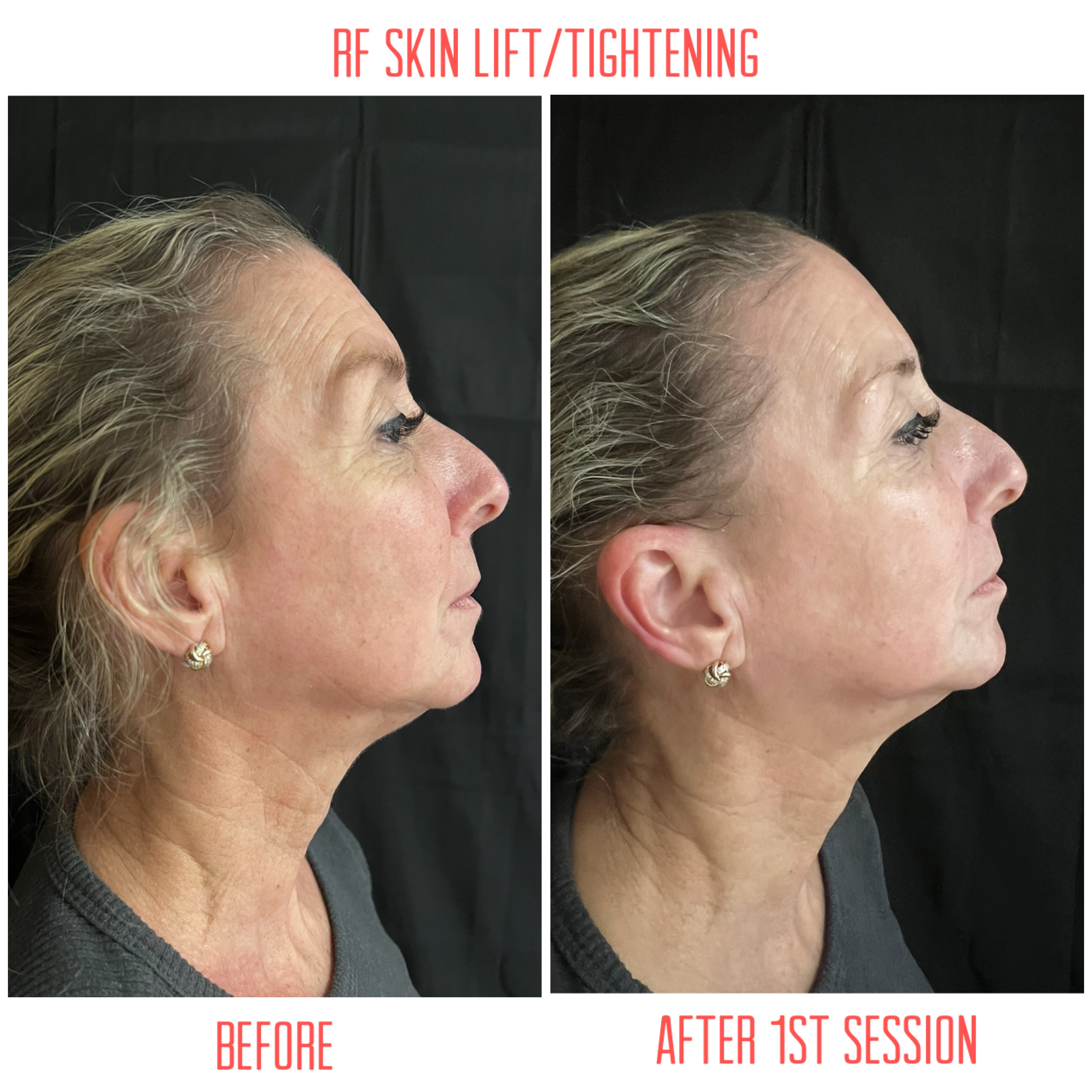 Radio Frequency Skin Lifting at Magnifique Laser Spa in Rockville Centre, NY