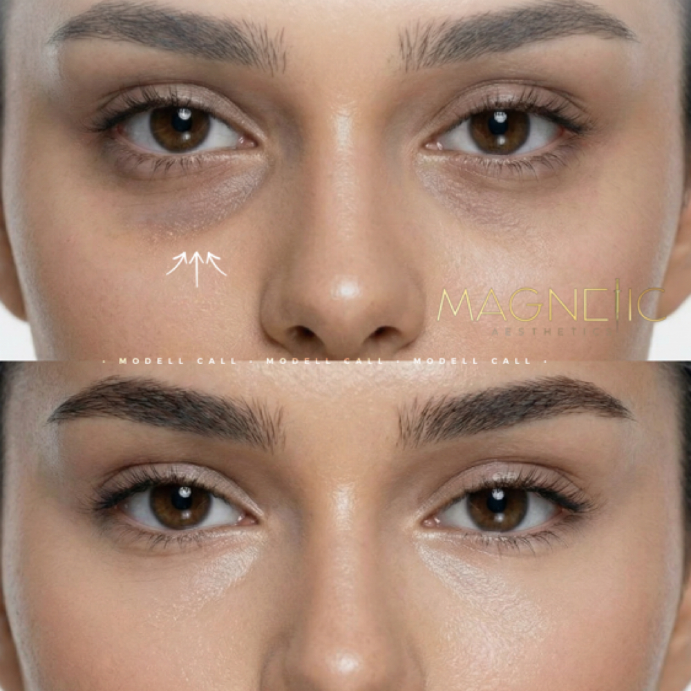 PRF Under Eye Model (orig $799) at Magnetic Aesthetics in Frisco, TX