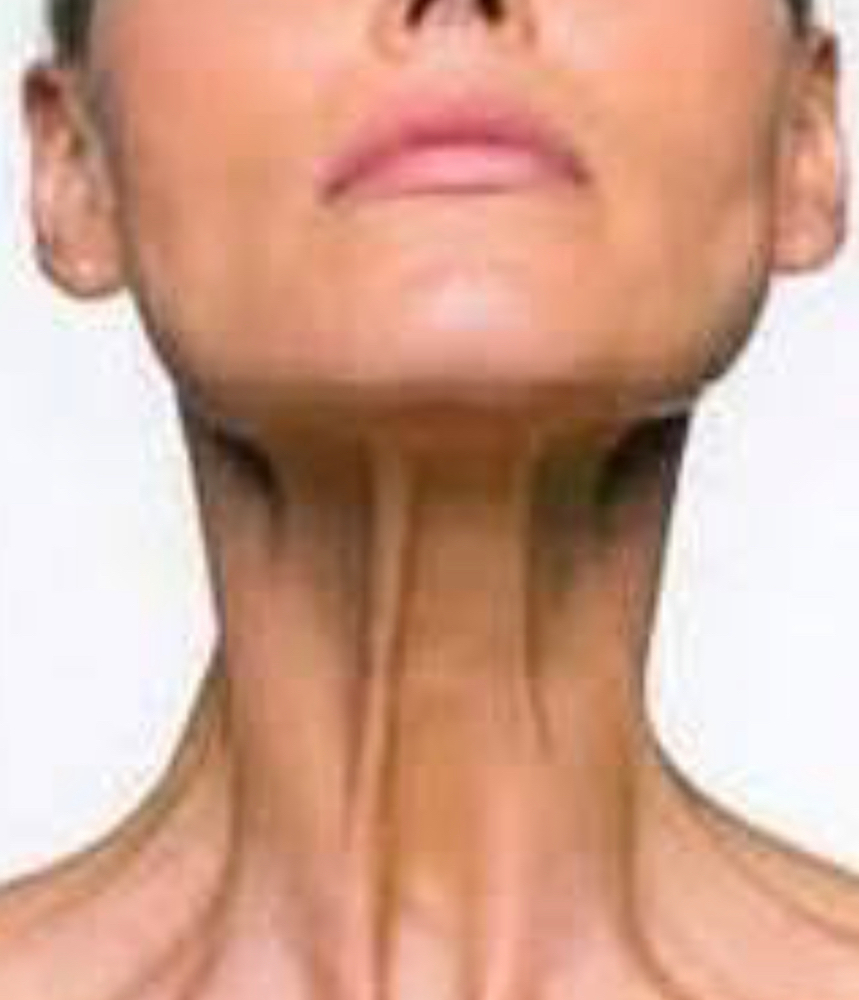 Neck TOX platysma Muscle