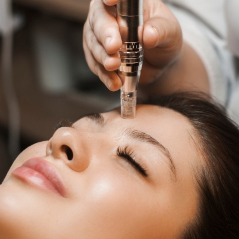 Microneedling at Skin & Toxx Medical Spa Westchase in Houston, TX