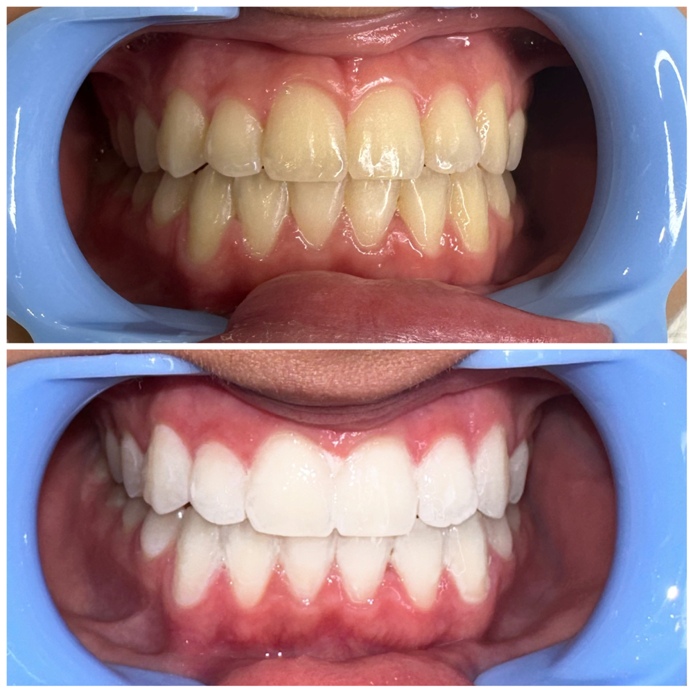Teeth Whitening