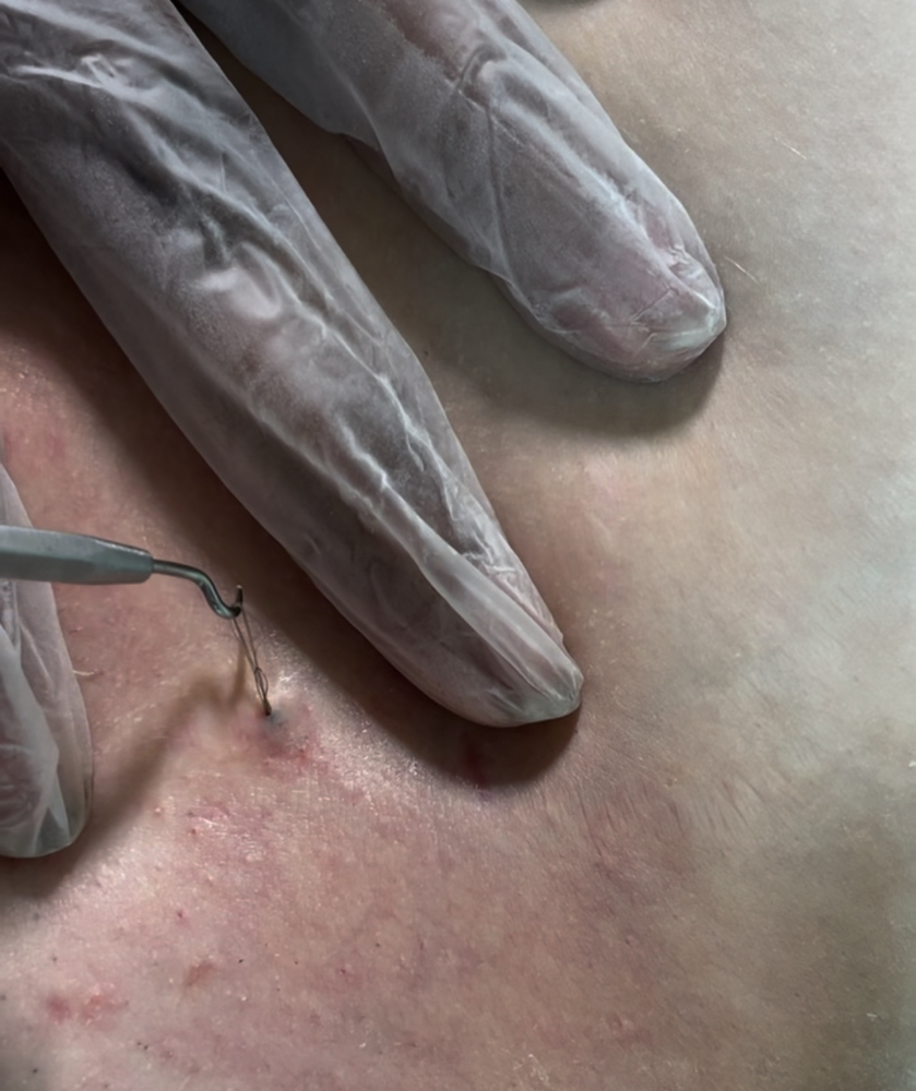 Corrective Vagacial
