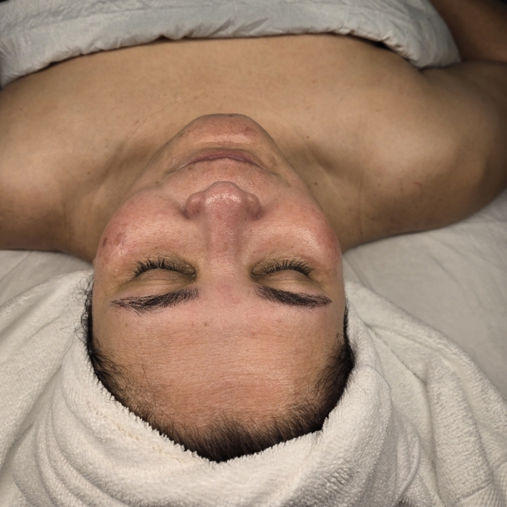 Microdermabrasion Facial at Midtown Esthetics in Raleigh, NC
