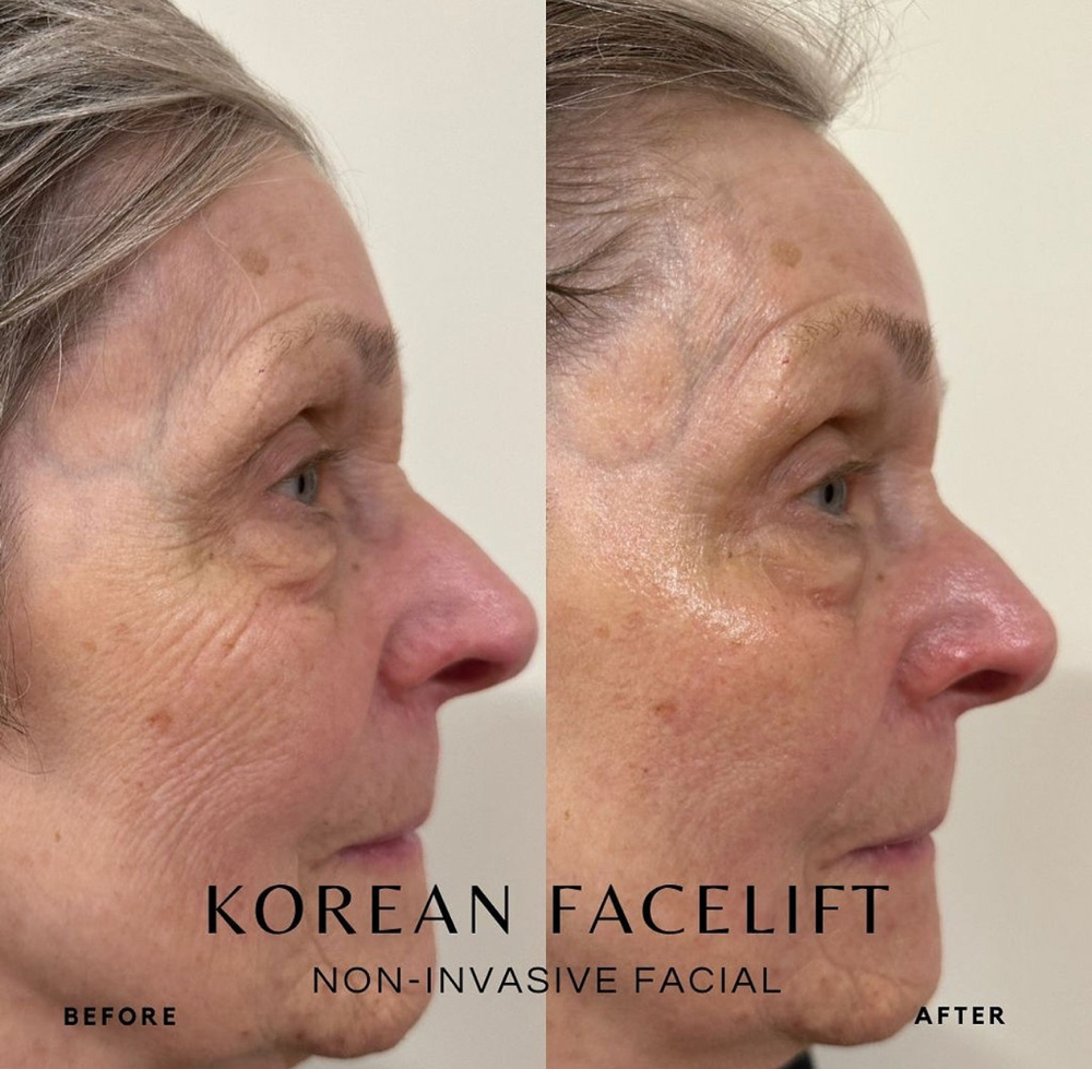 Korean Anti-Aging Treatment