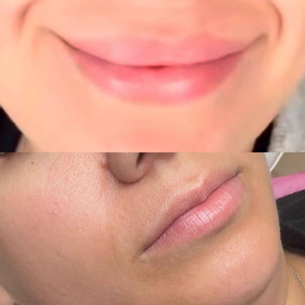 Filler Dissolver at Balance.Bar.Aesthetics in Berkeley, CA