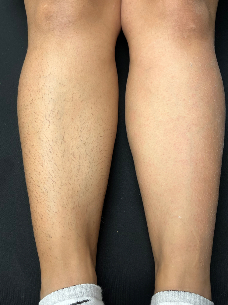 Legs (Full)