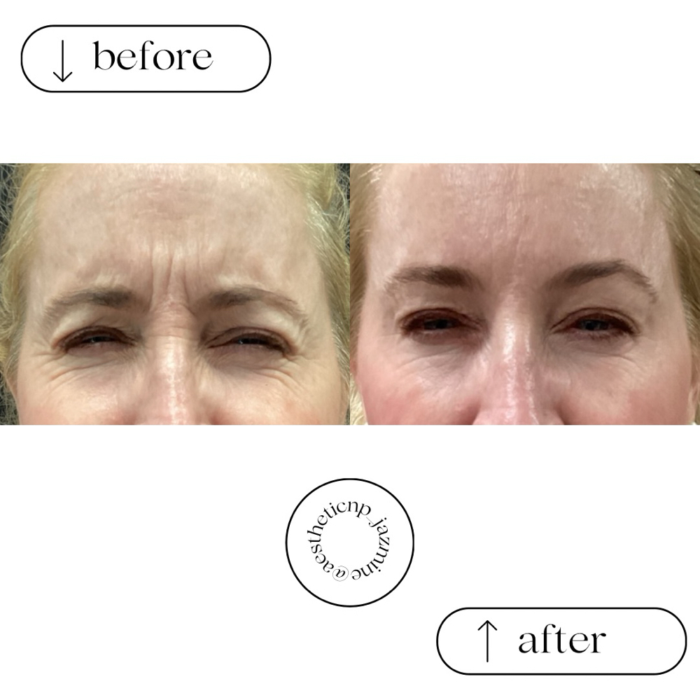 Frown Lines - Brow Focus at Amoris Aesthetic in Hillsborough, NJ